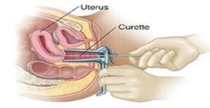 Read more about the article Pros and Cons of Dilation and Curettage (D&C)