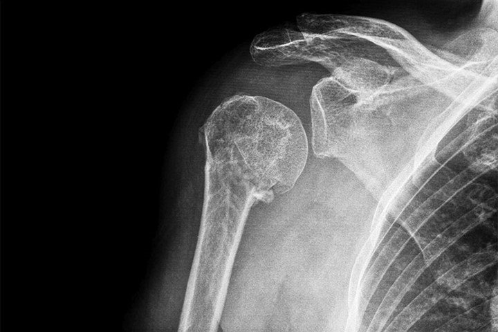 You are currently viewing Pros And Cons Of Reverse Shoulder Replacement